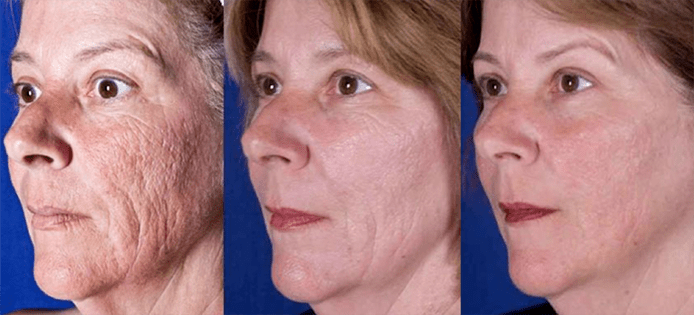Rezultatas po lazerinės veido odos atnaujinimo procedūros