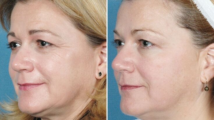nuotraukos prieš ir po aparatinės odos atjauninimo