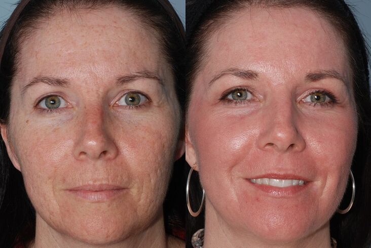 prieš ir po aparatinės odos atjauninimo