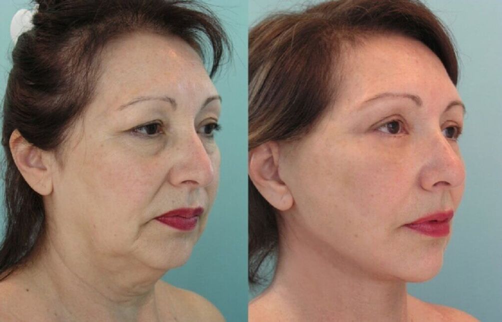 nuotrauka prieš ir po odos atjauninimo